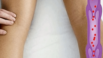 Motivele dezvoltării varicelor extremităților inferioare