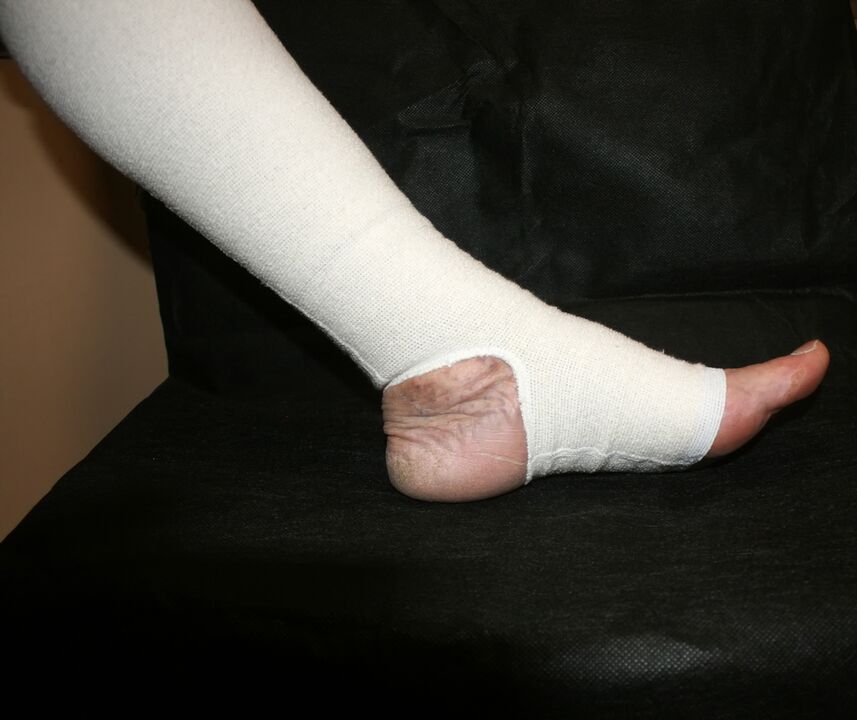 Tricot de compresie pentru varice