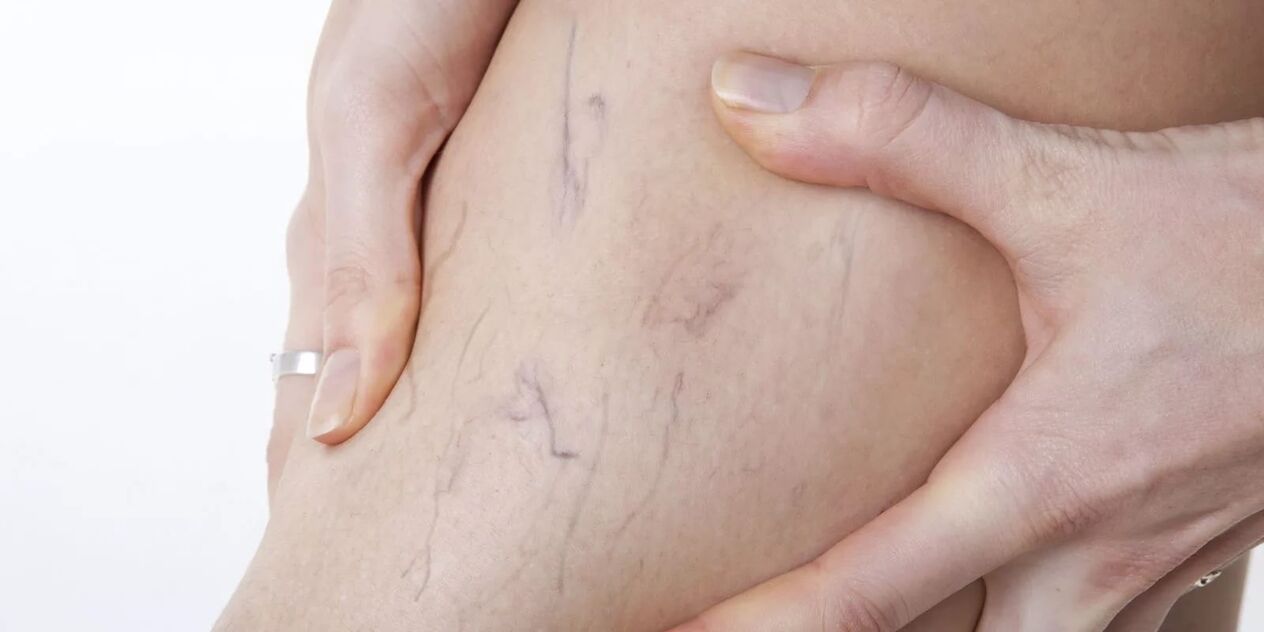 Înainte de a utiliza crema de varicon